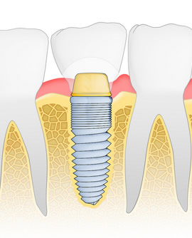 dental-implants