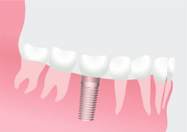 A mini dental implant can be seen among regular teeth within a person's gums and jaw.