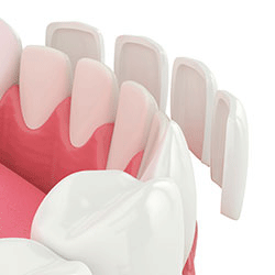 Dental Lumineers